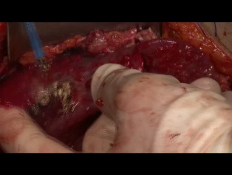 Chirurgische Aspekte von Pseudomyxoma Peritonei