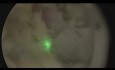 Holmium-Laser-Enukleation der Prostata (HoLEP)