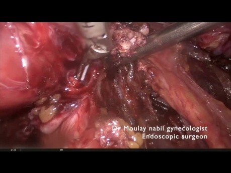 Hysterektomie bei schwerer Endometriose