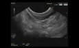 Endoskopischer Ultraschall einer submukösen Magen-Antral-Läsion