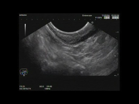 Endoskopischer Ultraschall einer submukösen Magen-Antral-Läsion