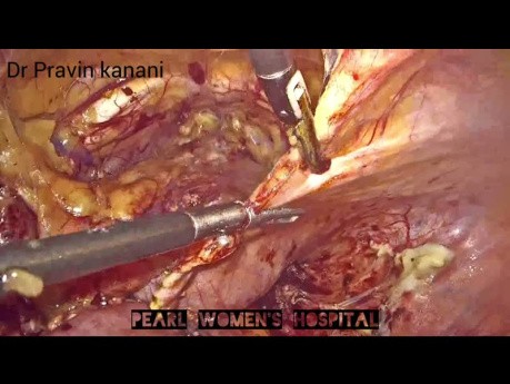 Harnleitermplantation mit Boari-Lappen