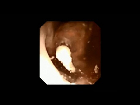 RIRS (Retrograde Intrarenal Surgery)