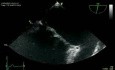Mitralinsuffizienz -  Marfan-Syndrom