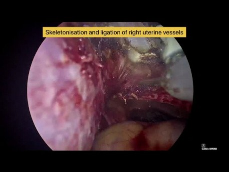 Totale laparoskopische Hysterektomie für einen Uterus mit Myom unter Verwendung eines einzigen Hybrid-Energiegeräts