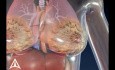  Brustkrebs - medizinische Animation 3D