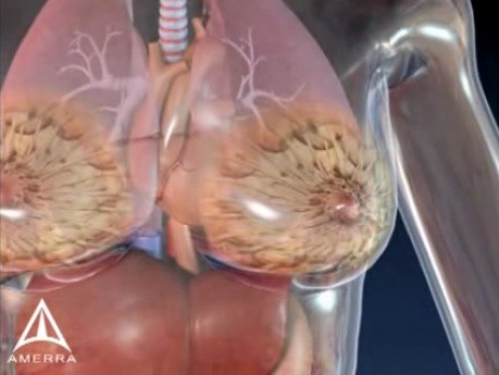  Brustkrebs - medizinische Animation 3D