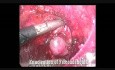 Endoskopische Fibroadenom-Exzision