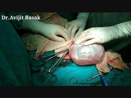 LAPAROTOMIE: Entfernung der großen Ovarialzyste