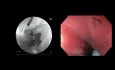 EUS-geführte Gastroenterostomie