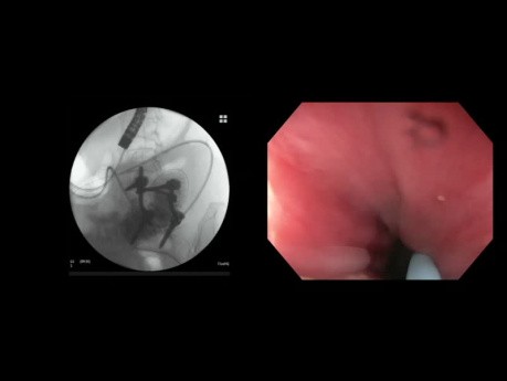 EUS-geführte Gastroenterostomie
