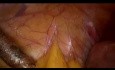 Laparoskopischer Verschluss eines Myomektomiedefekts mit bidirektionalem Quill®-Widerhaken-Nahtmaterial