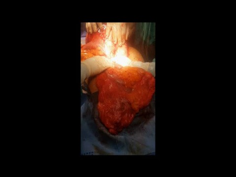 Huge leiomyosarcoma 