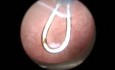 Mikrohysteroskopie – Tipps und Tricks bei Stenosen am äußeren Ausgang des Zervikalkanals