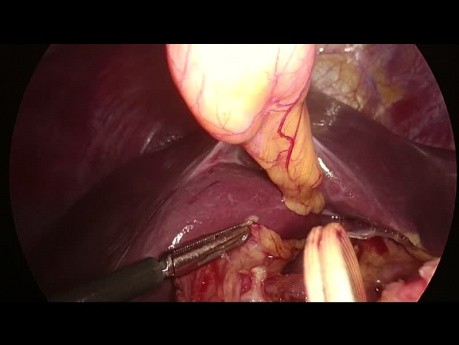 Laparoskopische RAMPS (radikale antegrade modulare Pankreatosplenektomie) mit Portalvenenresektion