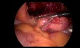  Laparoskopische Chirurgie - Urachus-Tumor-Entfernung