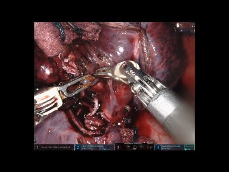 Robotische rechte mittlere Lobektomie der Lunge