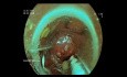 EFTR (Endoskopische Vollwandresektion) der Basis eines Polyps im Sigma-Dickdarm