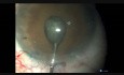 Ovale Kapsulorhexis bei engen Pupillen