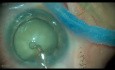 Intumeszierender Katarakt, Phakoemulsifikation