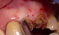 Extraction and Immediate Placement (Flapless)