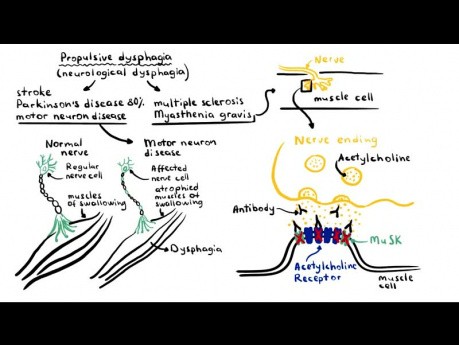 Dysphagie (Schluckbeschwerden) – Ursachen, Pathophysiologie, Klassifikation, Untersuchung