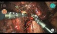 Keilresektion des rechten Mittellappens, Gefrierschnitt (Adenokarzinom), Mittellappenektomie und Lymphadenektomie mit dem chirurgischen Robotersystem Versius
