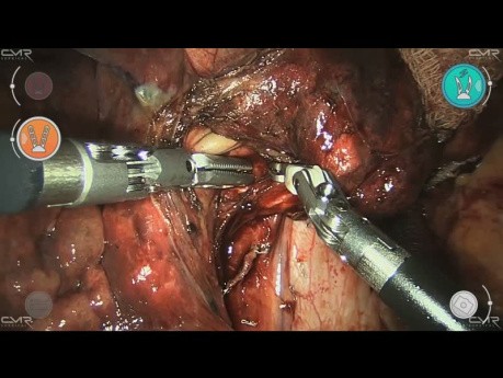 Keilresektion des rechten Mittellappens, Gefrierschnitt (Adenokarzinom), Mittellappenektomie und Lymphadenektomie mit dem chirurgischen Robotersystem Versius