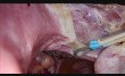 Totale laparoskopische Hysterektomie mit Bipolare Anwendungstechnik