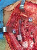 Selektive Neck dissection bei papillärem Schilddrüsenkrebs