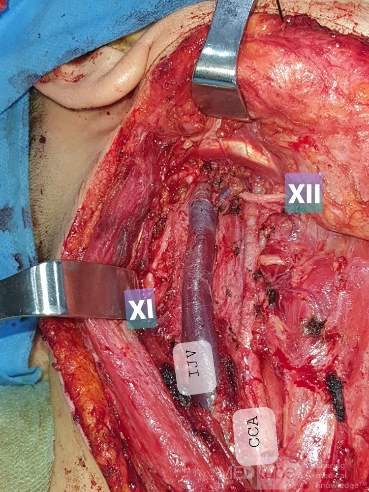 Selektive Neck dissection bei papillärem Schilddrüsenkrebs