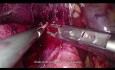 Laparoskopische rechte Hemihepatektomie - Nähen der Hohlvene, Blutung aus dem Leberparenchym