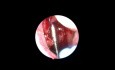 Adenoidektomie mit einem Shaver