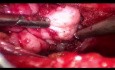 Endoskopische Entfernung eines Riesenfibroadenoms