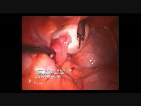 Ovarialfensterung und Chromopertubation
