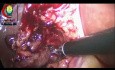 Die Dissektion der Lymphknoten im Porta Hepatis erfordert möglicherweise einen Chirurgen, der feinfühliger ist als ich.