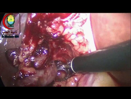 Die Dissektion der Lymphknoten im Porta Hepatis erfordert möglicherweise einen Chirurgen, der feinfühliger ist als ich.