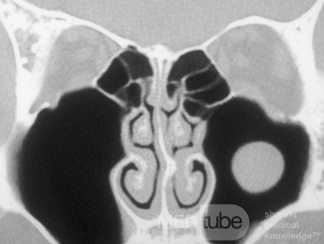 Kieferhöhlenzyste (CT-Bild)