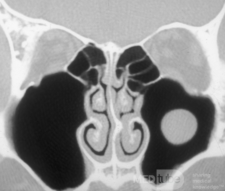 Kieferhöhlenzyste (CT-Bild)