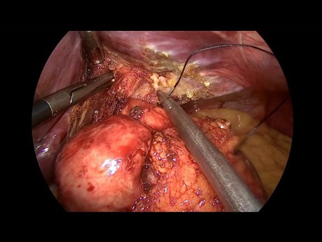Neue Durchführung der Nissen-Fundoplikation nach erneutem Auftreten von gastroösophagealem Reflux (GERD).