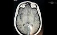 Erweiterter transnasaler, transsphenoidaler, transpterygoidaler Zugang zur Resektion eines invasiven Hypophysenadenoms
