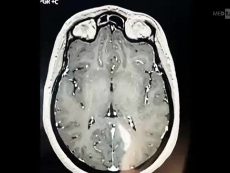 Erweiterter transnasaler, transsphenoidaler, transpterygoidaler Zugang zur Resektion eines invasiven Hypophysenadenoms