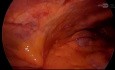 Laparoskopische Fundus-Cholezystektomie bei Patient*in nach vorangegangener Cholezystostomie