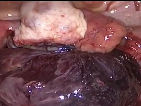Adnextorsion