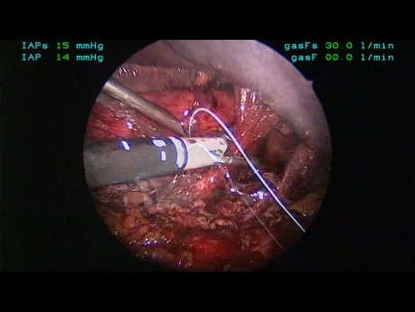 Laparoskopische Chirurgie zur Behandlung der parahiatalen Hernie