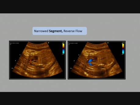  Koarktation der Aorta