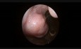 Diagnostische Endoskopie der Mundhöhle und des Kehlkopfes