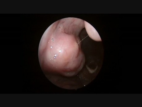 Diagnostische Endoskopie der Mundhöhle und des Kehlkopfes