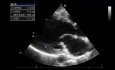Ein Echokardiographie-Quiz: Wie schwer ist eine Aorteninsuffizienz?