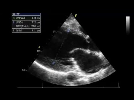 Ein Echokardiographie-Quiz: Wie schwer ist eine Aorteninsuffizienz?